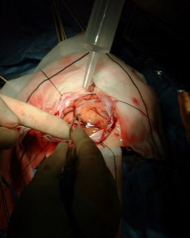 Brain surgery